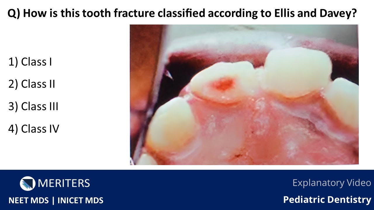 NEET MDS INICET Pediatric Dentistry Traumatology Explanatory
