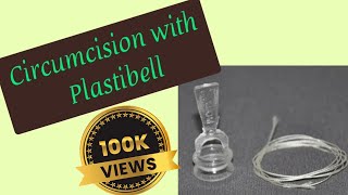 Circumcision with Plastibell | Educational purpose