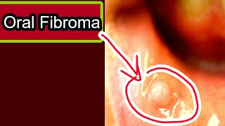 Oral Fibroma: Symptoms, causes, treatment