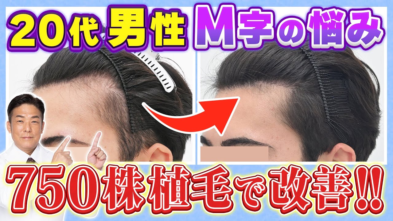 M字男性必見】20代の薄毛・おでこの悩みを解決！最新AGA治療とは
