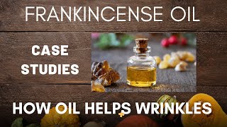 The Benefits of Frankincense Oil for Wrinkles - Case Studies #frankincenseoil  #wrinkles