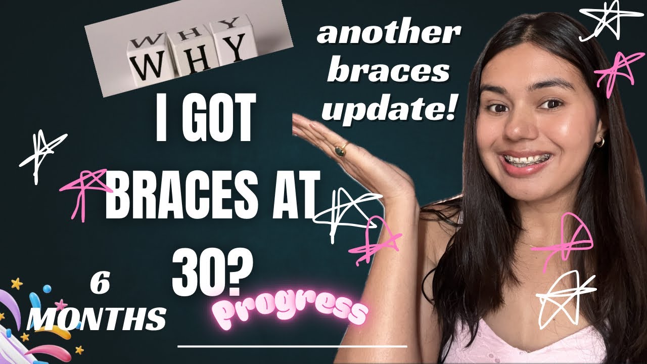 Why I Got Braces at 30! | 6-Month Update & Progress Revealed!