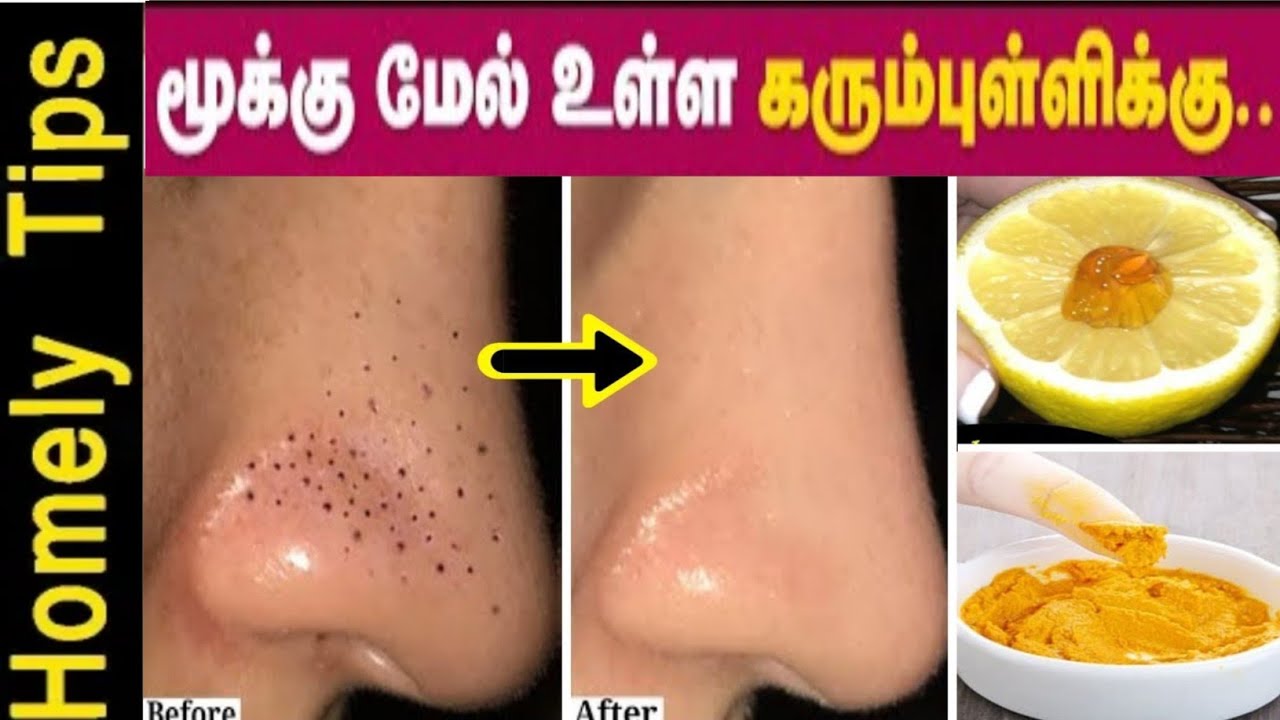 மூக்கில் உள்ள கருப்பு கோடு Black Heads White Dead CELLS சுலபமா Remove-ஆக இந்த மாதிரி செஞ்சு பாருங்க