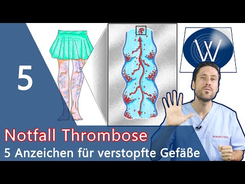 Video: Poplitealvenenthrombose: Symptome, Behandlung Und Mehr