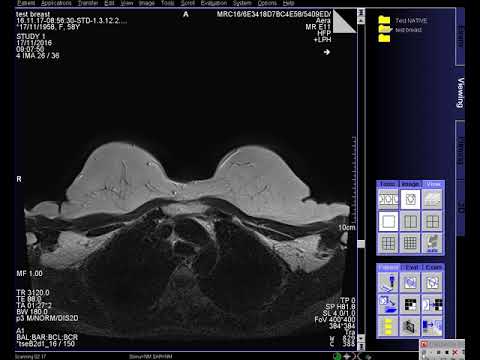 MRI-Breast manual - Siemens Aera 1.5T