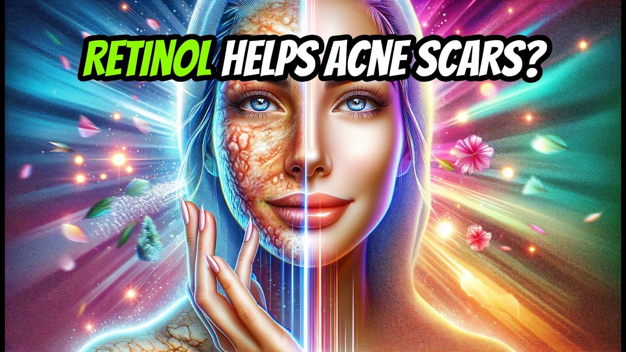 What Does Retinol do for Acne Scars? 