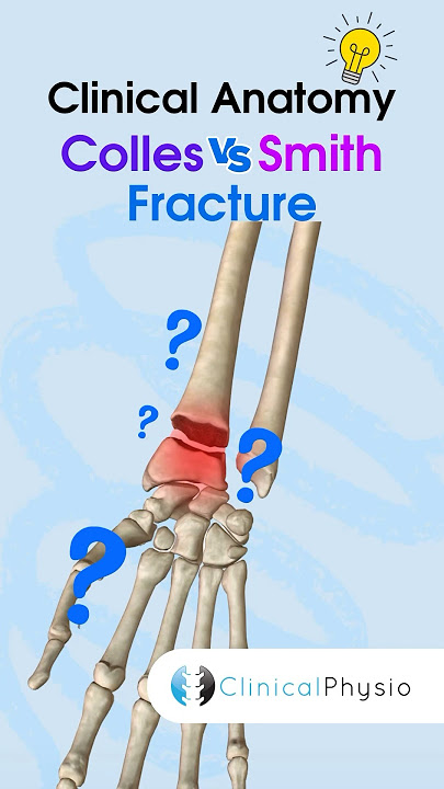 Colles vs. Smith Fracture #physicaltherapy #physiotheraphy #fracture #wrist