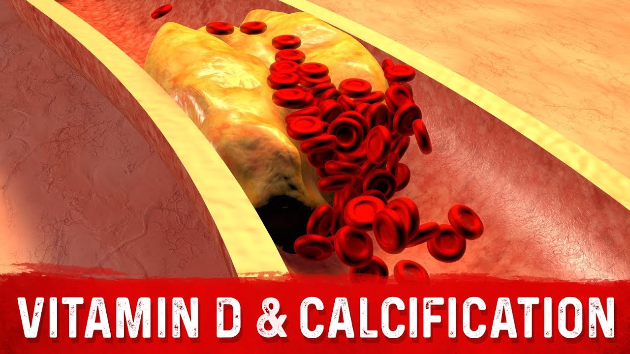 Does Vitamin D Clog Arteries?