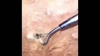 Cravos Enormes, Gigantes, Vídeo Incrível Espremendo Cravos E Espinhas