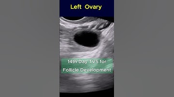 Good Size Follicle to Conceive - 14th Day TVS Ultrasound   #pregnant #infertility #pregnancyjourney