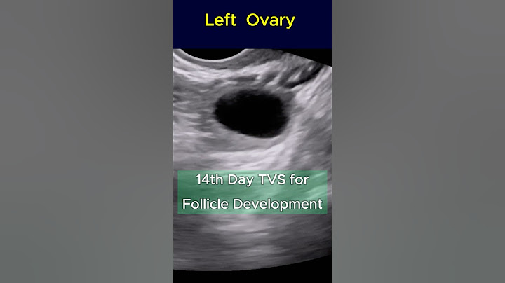 Good Size Follicle to Conceive - 14th Day TVS Ultrasound   #pregnant #infertility #pregnancyjourney