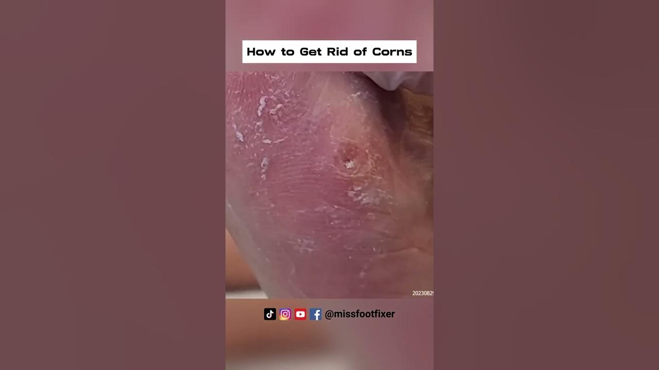 How to Get Rid of Corns on the Side of Your Foot By Foot Specialist ...