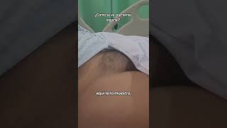 ¿Cómo se ve una hernia inguinal al pujar? 💡#hernia #cirugia #salud ¿Cómo se ve una hernia inguinal al pujar? 💡#hernia #cirugia #salud