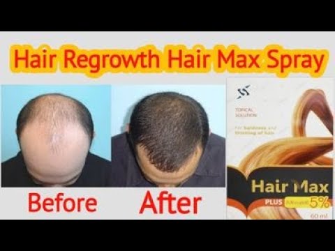 hair max plus minoxidil 5 side effects