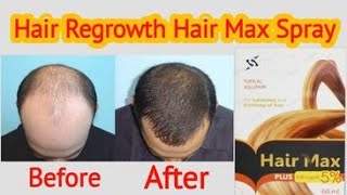 hair max plus minoxidil 5 side effects