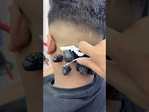 ازالة الحباية المتسلطنة من الدماغ       