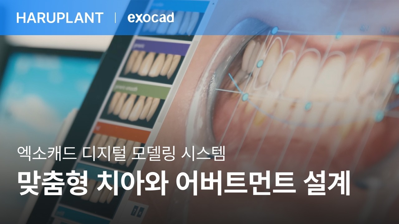 독일 엑소캐드 디지털 모델링 시스템, 정밀한 맞춤 보철 설계로 임플란트 완성도를 높이다