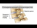 Спондилолизный спондилолистез