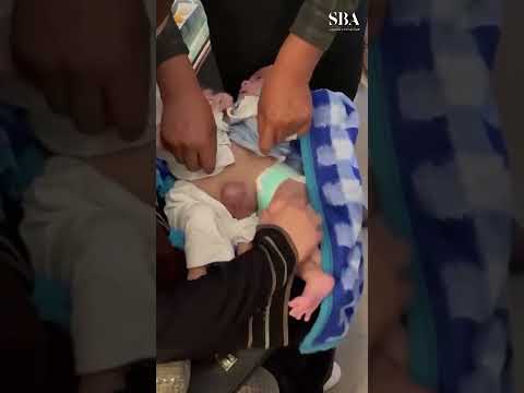 عاجل السعودية مشهد للتوأم السيامي العراقي علي وعمر قناة السعودية