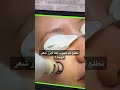 ليزر ازالة شعر الوجه
