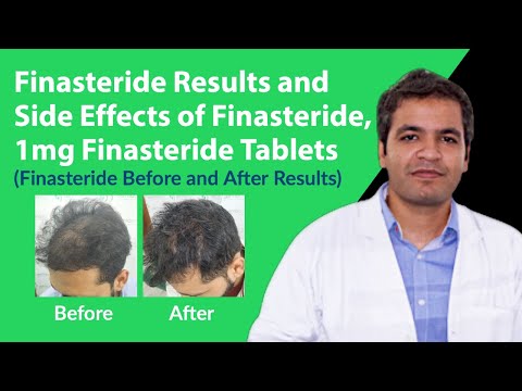 Video: Finasteride - Instruktioner Til Brug Af Tabletter, Anmeldelser, Pris, Analoger