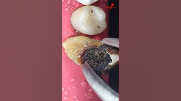 Tooth Extraction | What to expect? #toothextraction