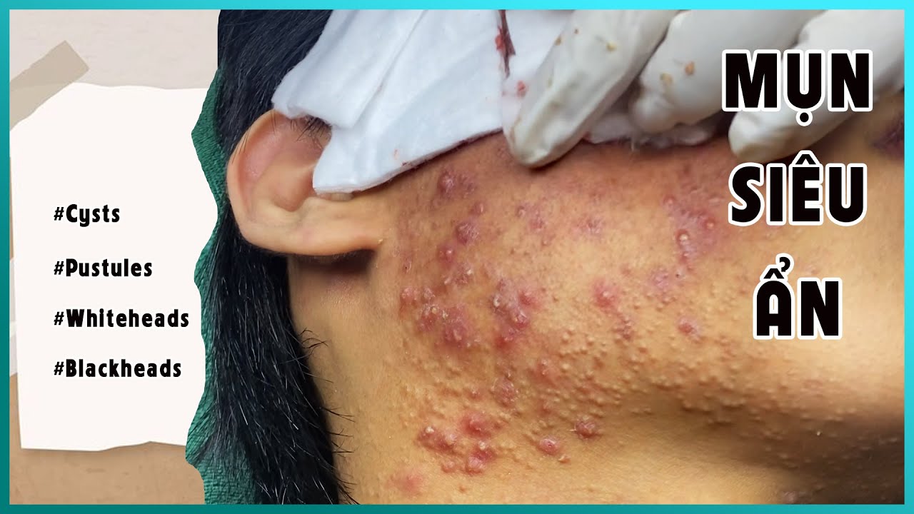 Big Cystic Acne Blackheads Extraction Blackheads & Milia, Whiteheads Removal Pimple Popping