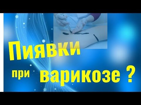 Пиявки как лечение варикоза. Мнение врача флеболога.
