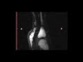 Realtime visualization of joint cavitation