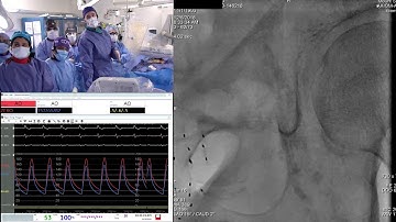 Evolut PRO Valve-in-Valve - Live Case 2