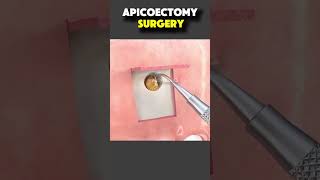 Public Awareness Apicoectomy Surgery   #GokarneshworDentalClinic #GokarneshworOralCare