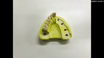 24 Scanning a wax-up case