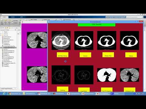 Early Detection of Lung Cancer using SVM Classifier in Biomedical Image Processing in Matlab