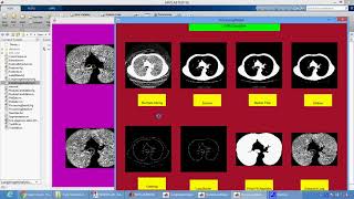 Early Detection of Lung Cancer using SVM Classifier in Biomedical Image Processing in Matlab