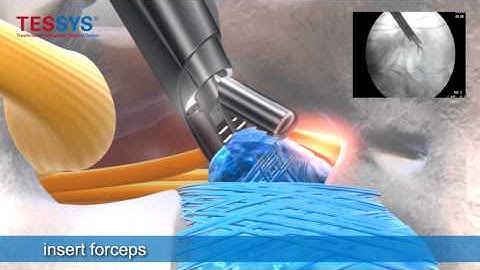 Treatment of herniated disc with TESSYS method prone position - Bandscheiben-OP mit TESSYS