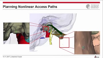 Planning nonlinear access paths for temporal bone surgery | IPCAI 2018