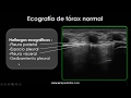 Ecografía de Derrame Pleural