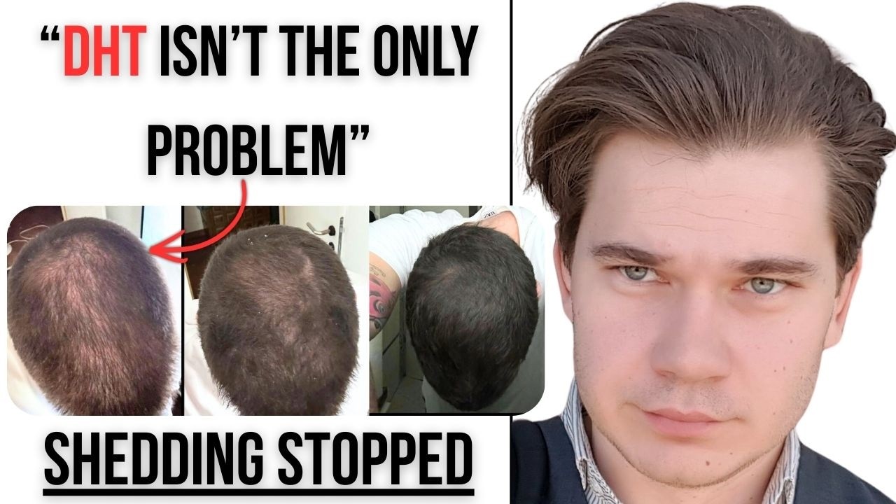 Два скрытых гормона, препятствующих росту волос (и дело не только в ДГТ)