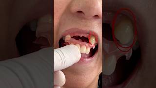 Flexible dental prosthesis #mrquin #altovalor