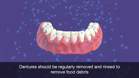 How To Clean a Denture Animation - Mouth Care Matters