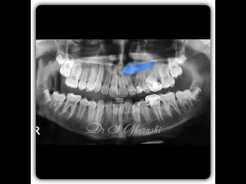 درمان دندان نهفته نيش افقي دکتر سعید قریشی 