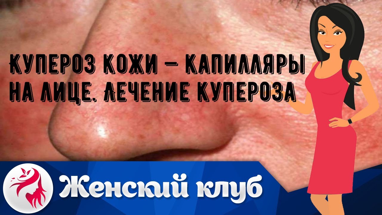 Купероз кожи — капилляры на лице. Лечение купероза - YouTube