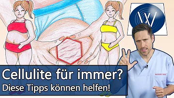 Warum habe ich so viel Cellulite?