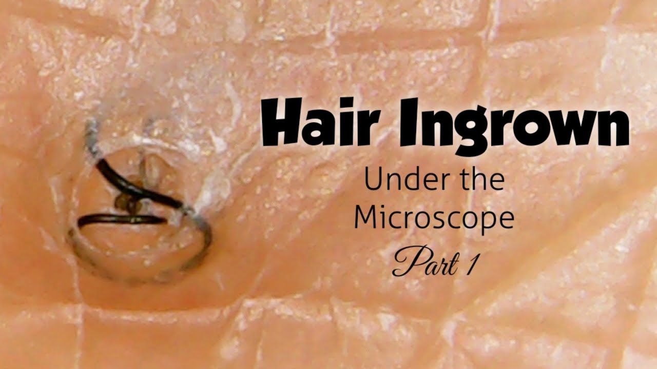 Hair ingrown under the microscope power of zoompart 1 YouTube