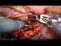 Complete Mediastinal LN dissection in Robotic assisted esophagectomy