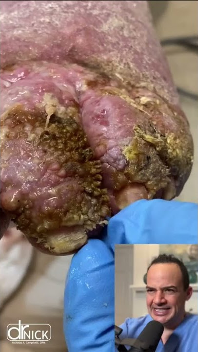 DOCTOR REACTS TO MAGGOTS ON A PERSONS FOOT!😱🤯 #shorts #reaction