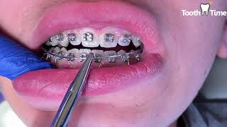 Braces check ups / T-loop wire / Kobayashi wire hooks / Rubber bands - Tooth Time New Braunfels