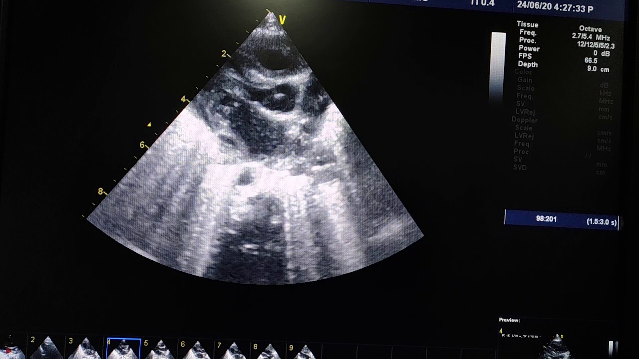 Persistent left superior vena cava 2 - YouTube