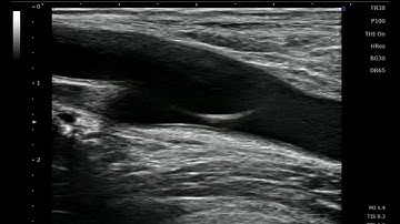 Ultrasound guided antegrade common femoral artery access to SFA（総大腿動脈順行性穿刺）