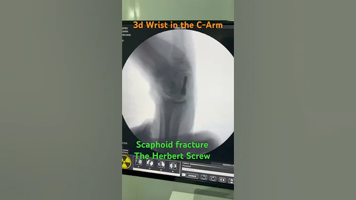 Fracture of the scaphoid.Screw fixation. #fracture #bonedoctor